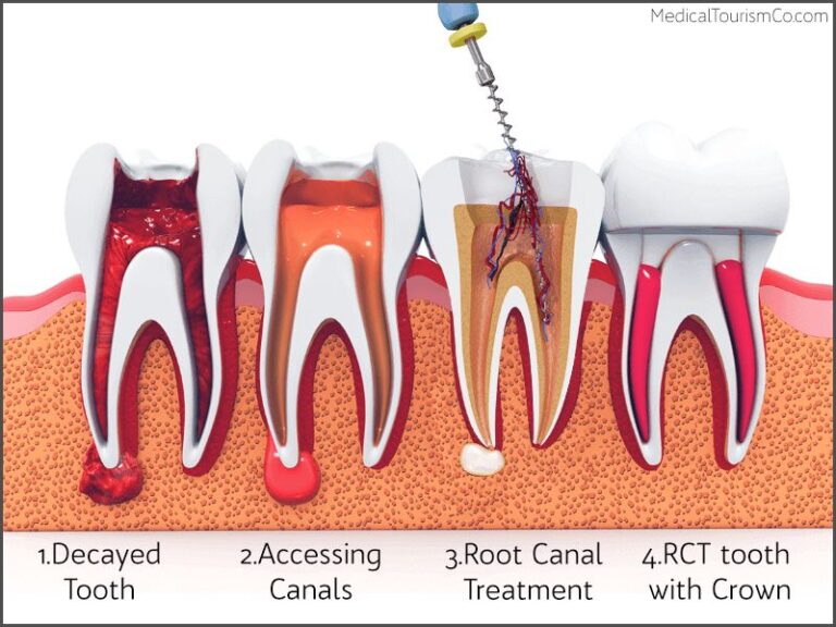 how-much-does-root-canal-treatment-cost-in-thailand-dentalbangkok