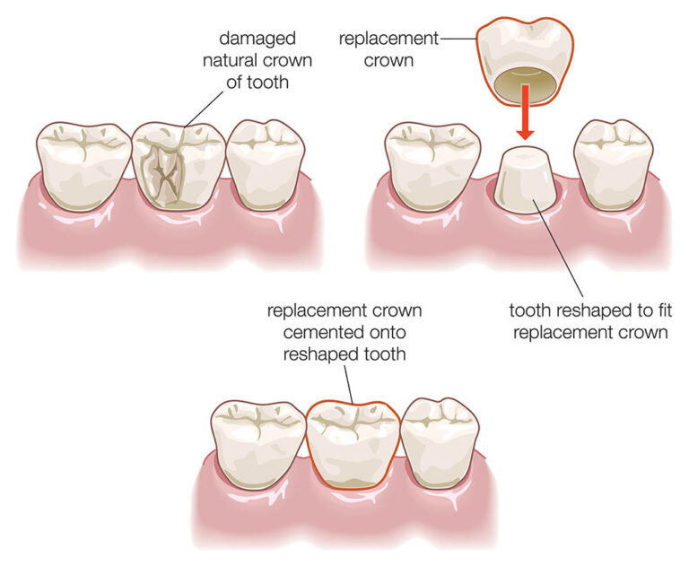 How much does a dental crown cost in Thailand? DentalBangkok